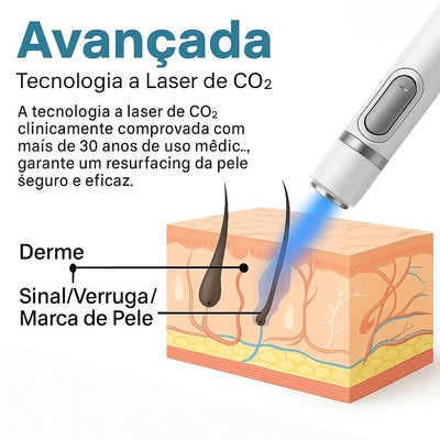 Caneta Laser MediSkin™ - Imagem 4